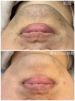 ヒスイ バイ アメイジング(Hisui by AMAZING)/【光脱毛】男性髭 &nbsp;IPL &nbsp;&nbsp;爆抜け