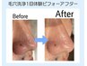 【平日限定】ゴッソリ！最新毛穴洗浄ハイドラフェイシャル＋高濃度VCパック◎