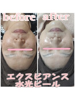 ピュルテ/水光ピーリングトリートメント