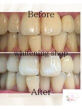 ホワイトニングショップ 本厚木店/【ビフォーアフター】2回目
