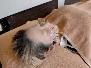 鍼灸整骨ミヤビ 札幌八軒(鍼灸整骨MIYABI)/電気を流すプルプル美容鍼★