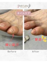 ペディラボ 荻窪店(Pedi Labo)/副爪や割れてしまう小指の爪