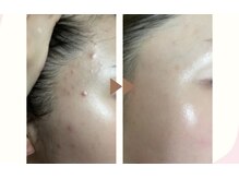 エステ大阪PONの雰囲気（ポールシェリー(フェイシャル)でニキビケア、自律神経の乱れにも）