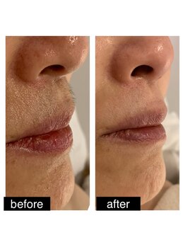 エスライン 円山店(Sline)/マスクで隠れて疎かに！？