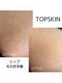 トップスキン 名駅(TOPSKIN)&nbsp;ヒップのざらつき、ブツブツ、肉割れもなめらかに肌質改善♪