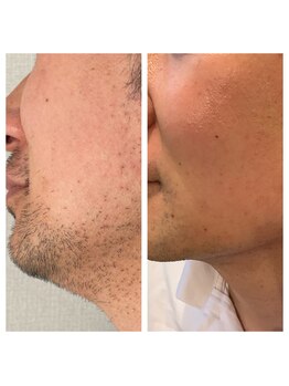 アイチューズ(ICHOOSE)/ヒゲ脱毛10回！