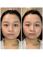 シエン ボーテ 馬車道 関内(Cyen BEAUTE)/一回でのビフォーアフター