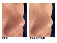 オーシャンブルー 佐世保店(OCEAN BLUE)/毛穴の黒ずみケア（毛穴洗浄）