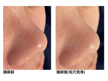 オーシャンブルー 佐世保店(OCEAN BLUE)/毛穴の黒ずみケア（毛穴洗浄）