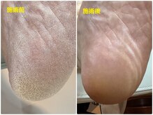 フットケアリストシュウ(footcarelist shu)/施術　角質ケアでふわかる♪