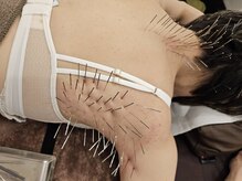 しつこい肩こりの原因を知り尽くした施術を行います。