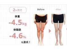 ウニ(uni)/【痩身】キャビ→ラジオ波→吸引