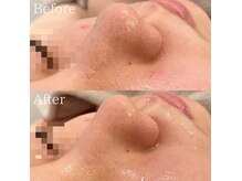 美肌育成サロン Soelの雰囲気（毛穴吸引で黒ずみ・詰まりを解消！）