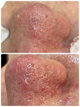 美プラスの写真/【沖縄初導入】最新毛穴洗浄！今すぐ毛穴をなんとかしたい方必見！笑撃の汚れが見える！取れる！感動体験！