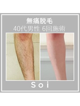 ソイ(Soi)/40代男性/スネ毛の脱毛