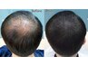 "THE SCALP INK"広範囲の方Oタイプ1回約10万発20万円→18万円"速攻変化"