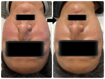 エフェクト 塚口店(effect)/Before After 40代/2回目