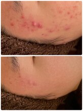 チュチュ(TUTU)/学割肌ケア