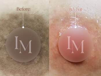 クローバー 松戸(clover)/【ルメラ】乳輪　黒ずみケア