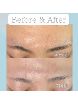 ニコ(Nico)/顔脱毛