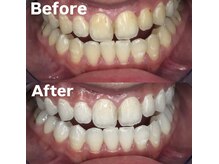 ホワイトニングビューティー 光の森店(WHITENING BEAUTY)/ホワイトニング♪