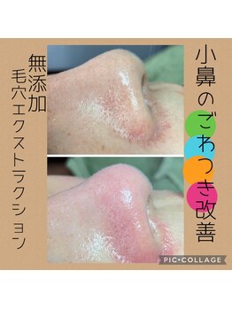 リンカ(Rinca)/毛穴綺麗！ゴワつき解消