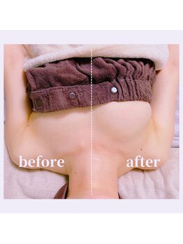 リノ 行橋(lino)/◇育乳症例◇30代、授乳経験有