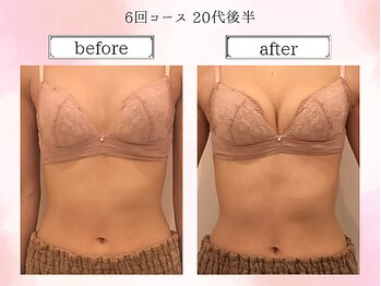 リール 恵比寿店(RIRE)/バストアップ症例【広尾恵比寿】