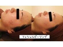 ビューティースパ/ニキビケア/肌質改善♪