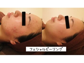 ビューティースパ/ニキビケア/肌質改善♪