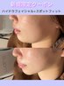 【毛穴洗浄/小顔たるみケア】ハイドラ＋スポットフィット13000円