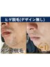 松戸最安値★【メンズヒゲ脱毛】何回でも同じ価格♪(範囲指定、デザインなし)