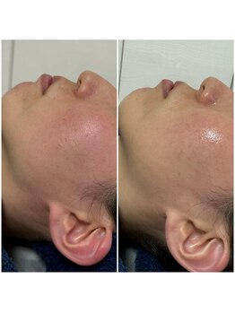 エステサロン ベルジュール/プラズマゼノ