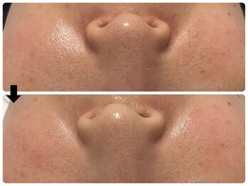 エフェクト 塚口店(effect)/Before After 30代/3回目