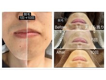 サマラボ 三軒茶屋(Sama Labo)/Before→After(顔脱毛)