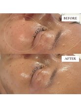 ミーティス/Gloss肌ピーリングで保湿ケア♪