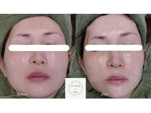 ココホワイトニング(coco whitening)/【TIPハーブピーリング】40代