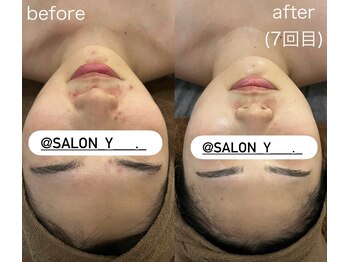 サロンワイアネシス(Salon y ANESIS)/ハーブピーリング　7回の変化