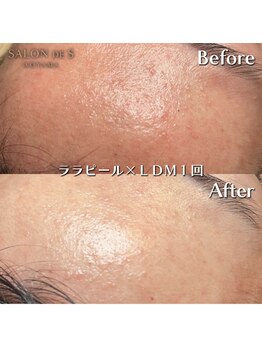 サロン ド エス アオヤマ(SALON DE S AOYAMA)/ララピール＆LDM（赤み）