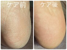 フォーチューン/足裏角質ケア♪