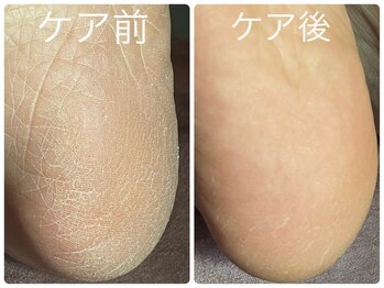 フォーチューン/足裏角質ケア♪