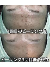 ヴィヴ 熊本(ViV)/【セルマンピーリング】9回目