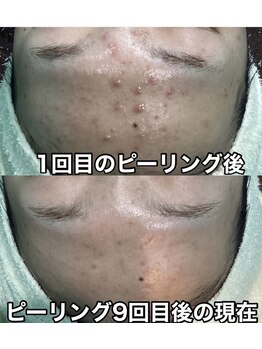 ヴィヴ 熊本(ViV)/【セルマンピーリング】9回目