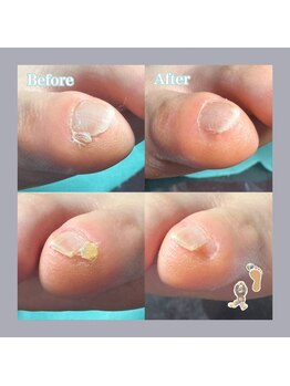 巻き爪補正店 天王寺店/歩くと痛い副爪