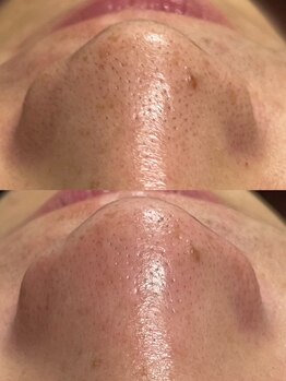 アットウィル 志木店(at will)/毛穴洗浄BeforeAfter