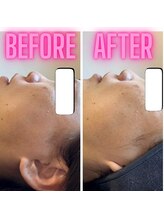 ヤーニング(yearning)/ハーブピーリング