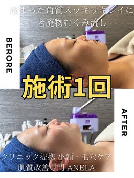 アネラ(ANELA)/即効果実感　3