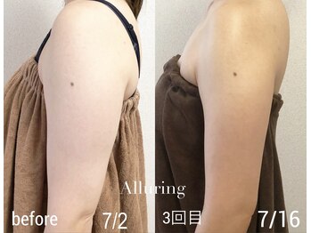 アルアリング 春日原(Alluring)の写真/最新の脂肪分解美容液で最短サポート！バストは残して華奢腕に☆おしゃれを楽しめるズル痩せ体験♪