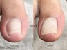 【FOOT】巻き爪矯正／親指2本 (オフ無し) ¥6000