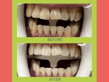 ココティ ホワイトニング(Cocotii)/ビフォーアフター